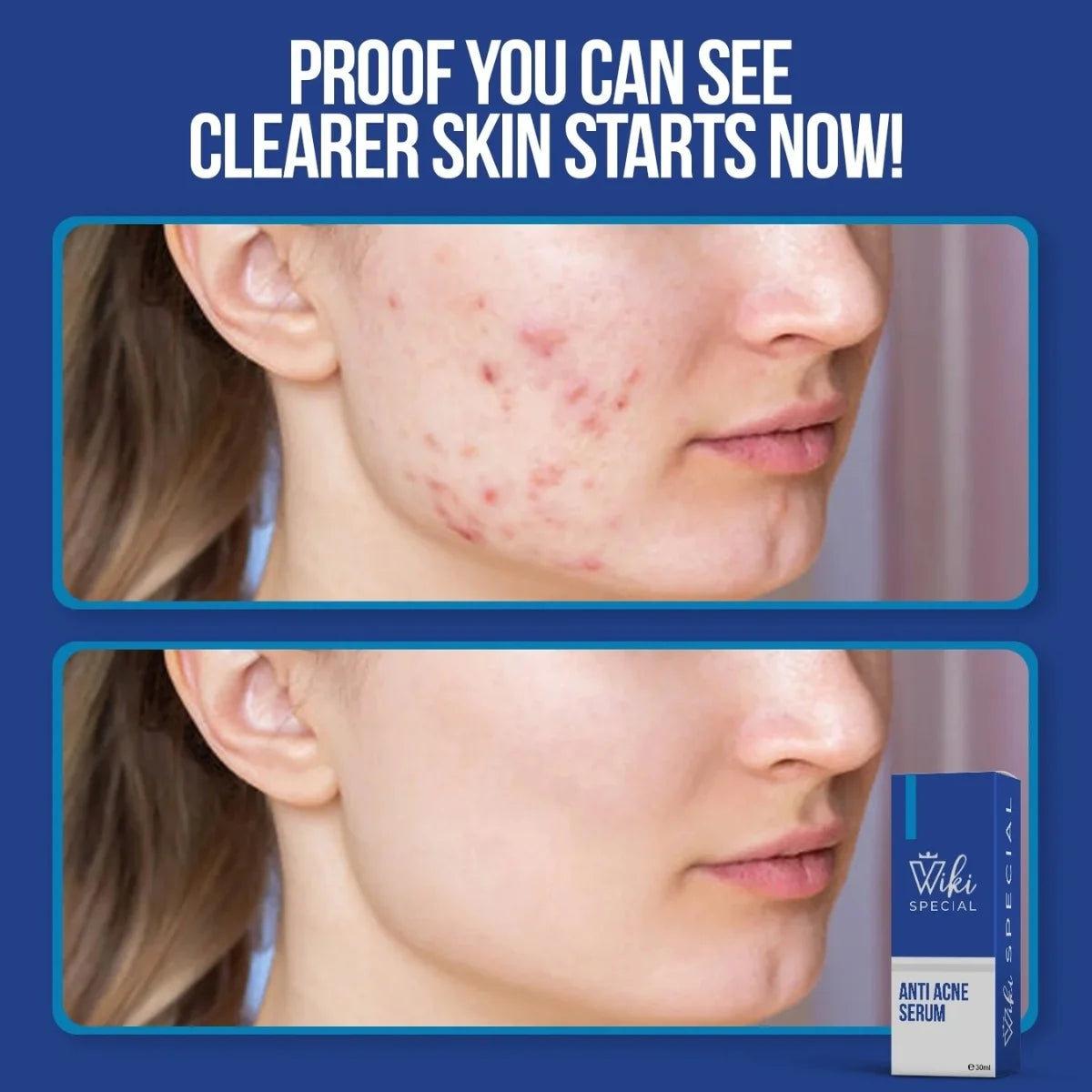 Wiki Special Anti-Acne Serum 30 ml | Clears Acne & Soothes Skin