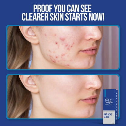 Wiki Special Anti-Acne Serum 30 ml | Clears Acne & Soothes Skin
